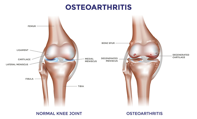Knee Osteoarthritis